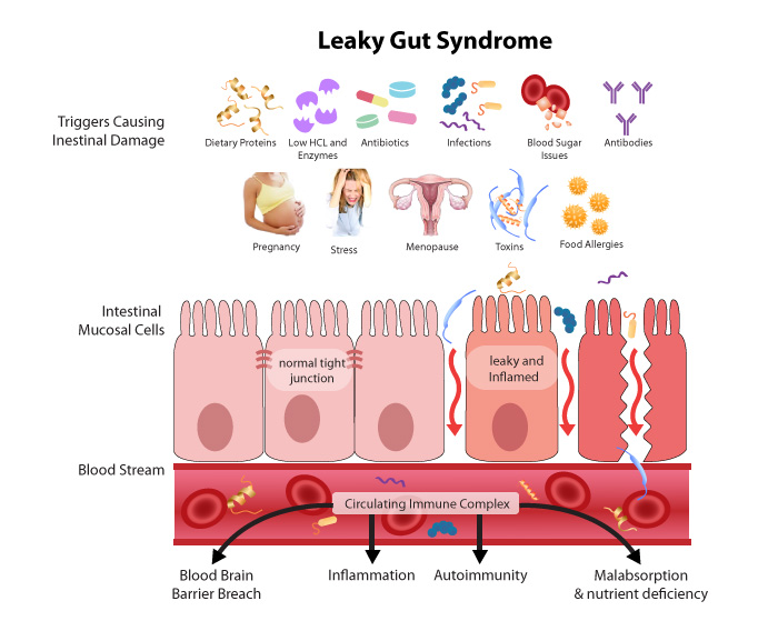 10 Home Remedies for Leaky Gut Syndrome and Your Digestion Health Overall