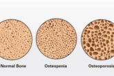Home remedies for osteopenia