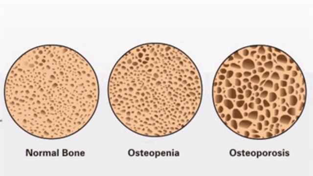 Home remedies for osteopenia