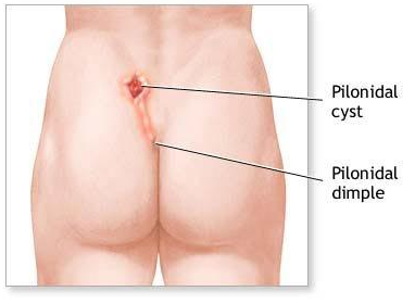 How to Get Rid of Pilonidal Cysts