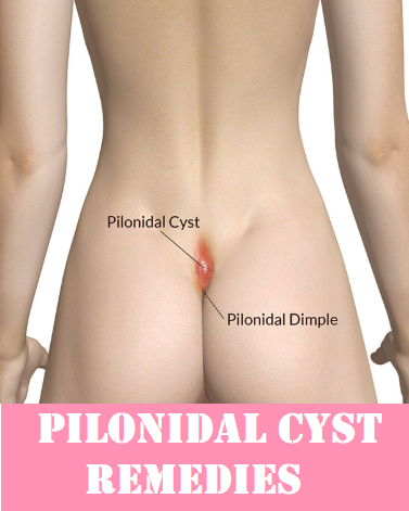 How to Get Rid of Pilonidal Cysts