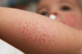 How to treat flea bites in humans