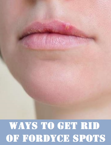 7 Best Home Remedies for Fordyce Spots That Are Worth Giving A Try